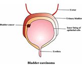 Urinary Bladder Cancer
